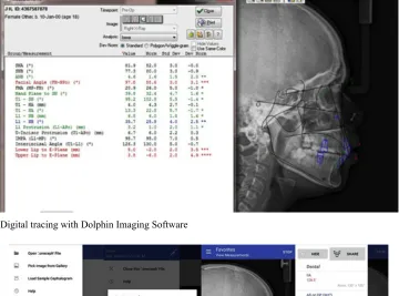 Fig. 1. Digital tracing with Dolphin Imaging Software
