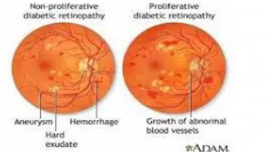 Figure 1.Proliferative and Non-Proliferative DR 