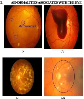 Figure 2.(a) Micro aneurysm (b) Haemorrhages (c) Hard Exudates (d) soft Exudates  