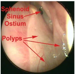 Fig 9 : Endoscopic Picture of Sphenoid Polyps 