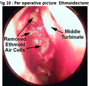 Fig 10 : Per operative picture  Ethmoidectomy 