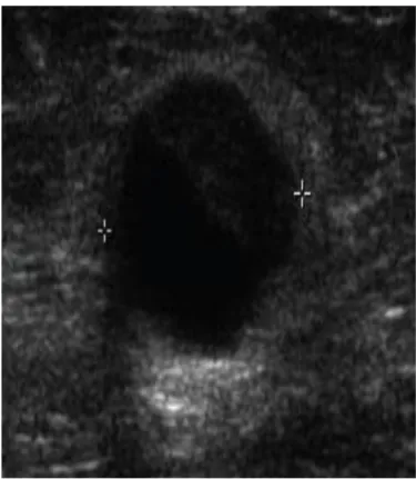 Figure 1 (C): Intraductal echogenic lesion with vascular flow. 
