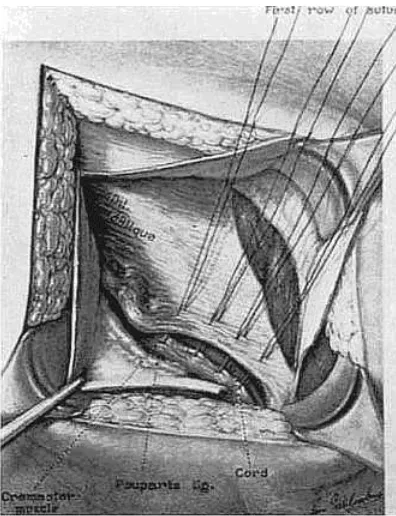 Figure 8. Relaxing incision. Required for most tissue repairs to reduce 