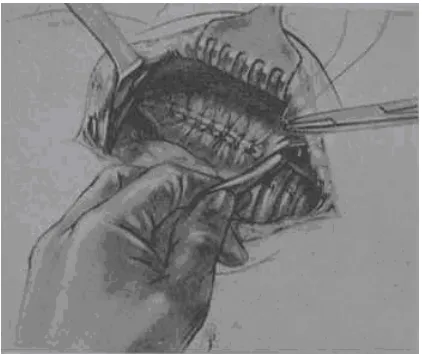 Figure 9. Preperitoneal suturing. The tranversus arch is sutured to the 