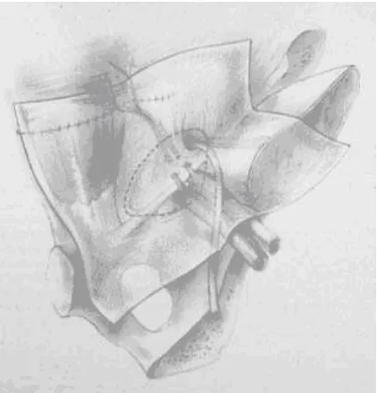 Figure 10. Stoppa procedure. The entire peritoneal bag is wrapped with a mesh graft. Expanding intra-abdominal pressure hold the graft in place without suture fixation