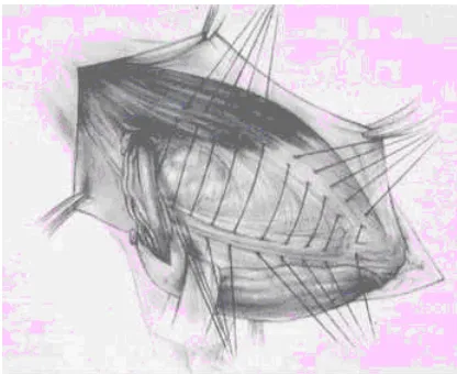 Figure 13. Modified Bassini. The posterior wall is not opened. Sutures 