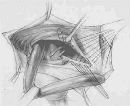 Figure 15. Cooper ligament repair. Approximation of the transversus arch to 