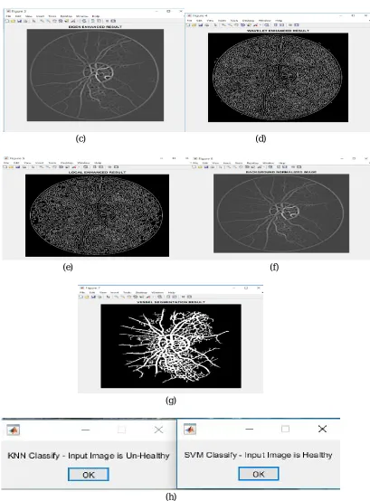 Figure 3.segmentation and classification results(a) input image (b)gray scale image(c)eigen enhanced image(d)wavelet enhanced result(e)local enhanced result (f)background normalize image(g)vessel segmentation result(h) svm and k-nn classification result 