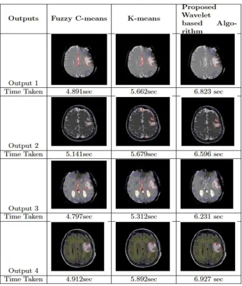 Figure 4 Skull Mask, Skull Removed and K -Means Segmented Image 