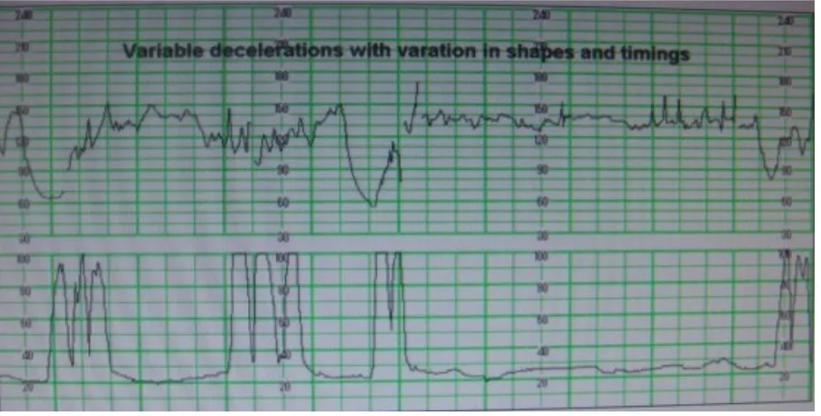 Fig 8: Fetal heart tracing showing variable deceleration