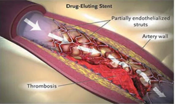 Fig. 10. Nanoburrs are tiny particles that travel through the blood stream, gets attached  to the affected arteries and deliver medicines like Paclitaxel directly to the damaged tissue.(Image credit Massachusetts Institute of Technology)