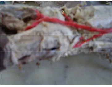 FIG – 40 ORIGIN OF COMMON INTEROSSEOUS   ARTERY FROM RADIAL ARTERY  