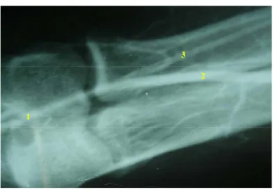 FIG – 48 CADAVERIC ANGIOGRAM STUDY - ORIGIN OF   RADIAL ARTERY  