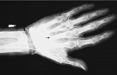 FIG – 50 CADAVERIC ANGIOGRAM STUDY – COURSE OF  RADIAL ARTERY  