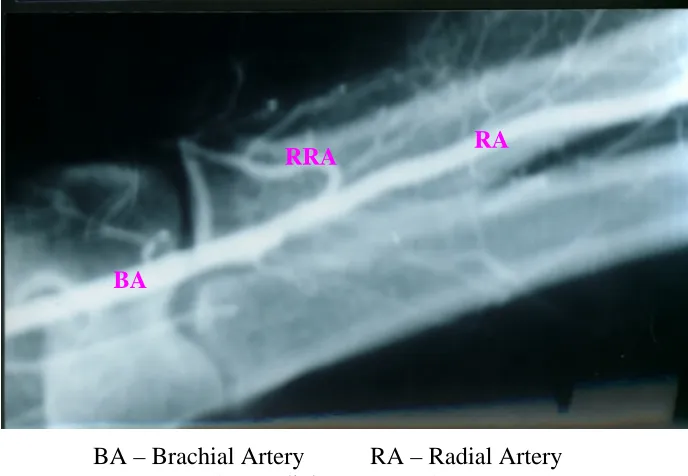 FIG – 53 CLINICAL STUDY BY ANGIOGRAPHY METHOD PSEUDOANEURYSM OF RADIAL RECURRENT ARTERY 