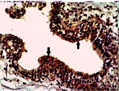 Fig. 7. Immunohistochemical expression of CD133 in BPH sample show 1+ staining (weak membranous &cytoplamic staining) of CD133 with nuclear involvement (black arrows)