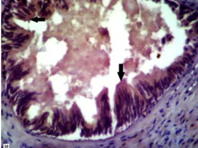 Fig. 8. Immunohistochemical expression of CD133 in NPCA sample show 1+ staining (weak membranous staining) of CD133 (black arrows)