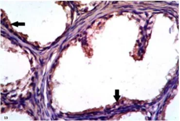 Fig. 12. Negative immunohistochemical expression of CD166 in BPH sample. X400