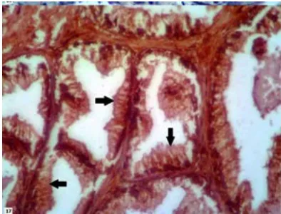 Fig. 16. Immunohistochemical expression of CD166 in NPCA sample show 1+ staining (weak membranous staining) of CD166 (black arrows)