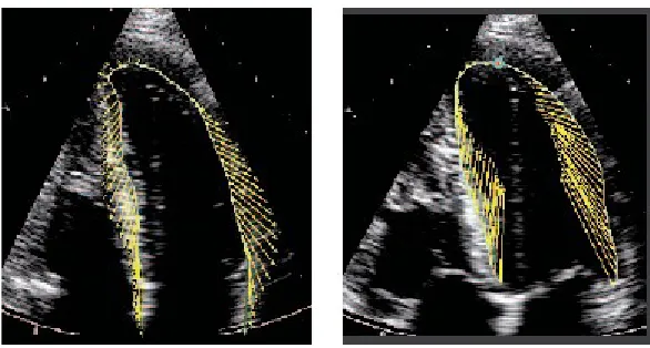 Figure 8. VVI analysis of a normal heart in diastole and systole