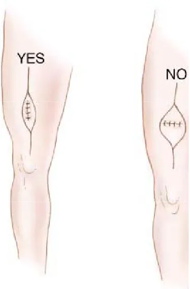 Figure . The smallest longitudinal incision that allows an adequate specimen to be obtained should be used