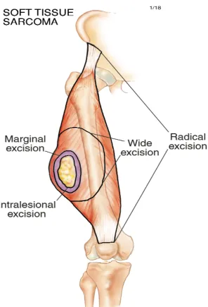 Figure. Various excision types for soft-tissue sarcoma. 