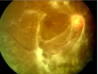 fig-10 PDR with Foveal tract ional retinal detachment