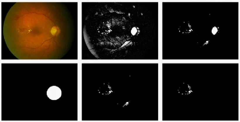 Fig. 2: (a) Original Image (b) Enhanced Image (c) Pre-exudates Binary Image (d) Optic disc mask Image (e) Possible Exudates Candidates Image (f) Final hard exudates Image