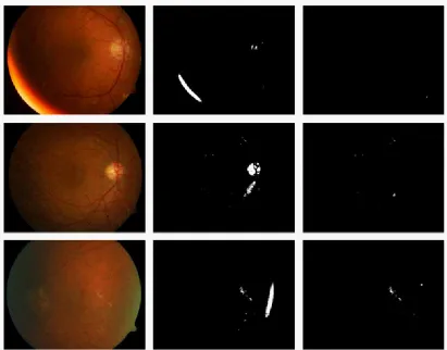 Fig. 3: (a) Original Image- yellowish bright region at the contour boundary (b) Binary Image (c) Final hard exudates Image (d) Original Image- Bright reflection near the optic disc (e) Binary Image (f) Final hard exudates Image (g) Original Image- greenish regions at the boundary of contour (h) Binary Image (i) Final hard exudates Image