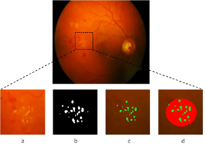 Fig. 4: Original Image marked with exudates present (a) Enlarged version of marked area (b) Detection result of the proposed method (c) Detection result on original image (d) Proposed method detection (by green) and ground truth (by red) on original image