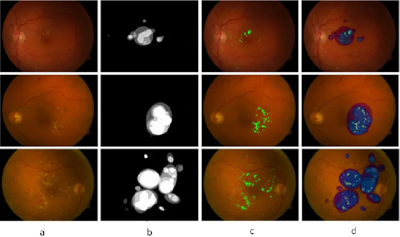 Fig. 5: (a) Patch from original images having hard exudates, CWS and HE (b) True Positives segmentation result of the proposed method without ambiguous false positives