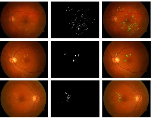 Fig. 7: (a) Original Image (b) segmented result on Diaretdb0 database (c) Proposed method results of hard exudates on original Image