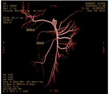 Fig. 3a  SMA and Splenic Artery as a common trunk 