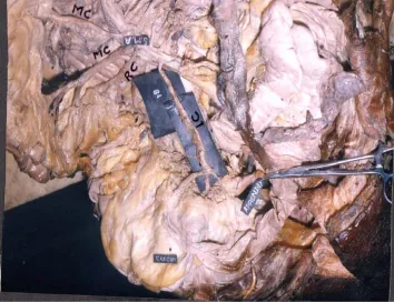 Fig 5a  Middle and Right colic artery as a common trunk  