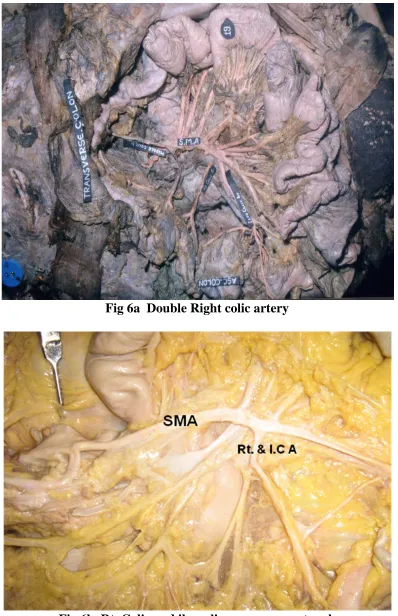 Fig 6b  Rt. Colic and ileocolic as a common trunk   