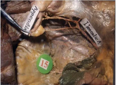 Fig 7a  Double Appendicular Artery  