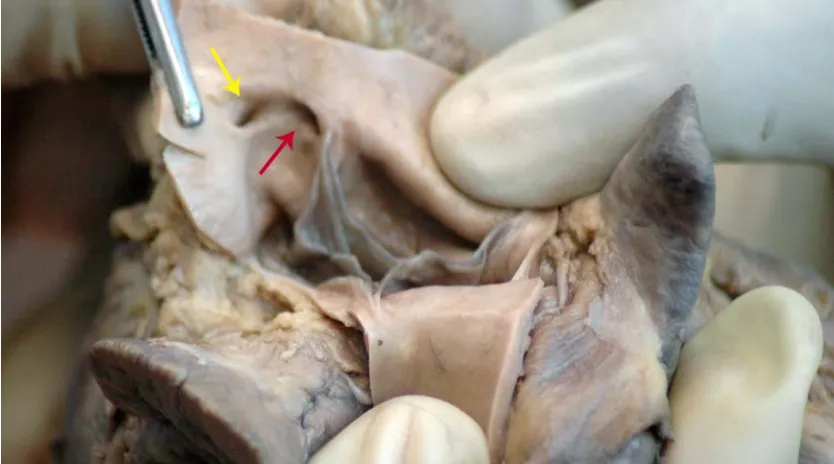 Fig.no 1- Right Coronary Ostium at the Left Posterior Aortic Sinus   →→Right Coronary Ostium →→Left Coronary Ostium   
