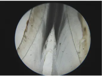 FIGURE .1SECONDARY  DENTIN  UP TO UPPER