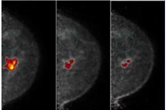 Fig. 3.4. Positron Emission Tomography of breast [21]