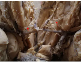 Fig: 4. Image of frontopolar branch in theA2 segment