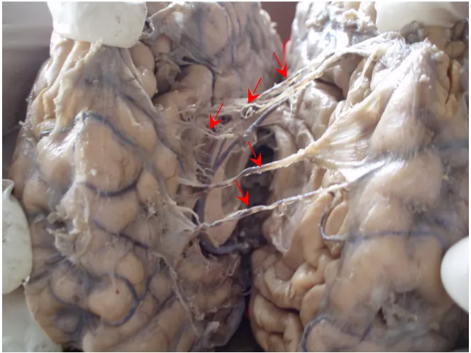 Fig: 13. A2 segment branches encroaching with the supero lateral surface