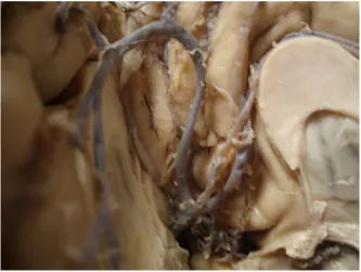 Fig: 17. Variation in Callosomarginal artery