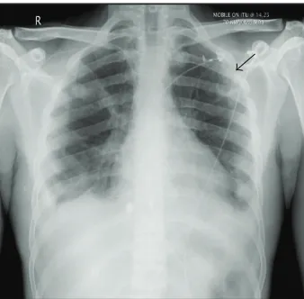 Figure 1: Chest X-ray on admission: arrow points to cavitatinglesion in the upper zone of the left lung