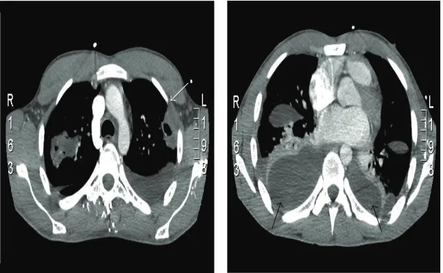 Figure 3: CT scan of the chest. Numerous bilateral pulmonary nodules (white arrow) can be seen with varying degrees of cavitation alongwith moderate bilateral pleural effusions and compressive atelectasis of both lung bases (black arrows).