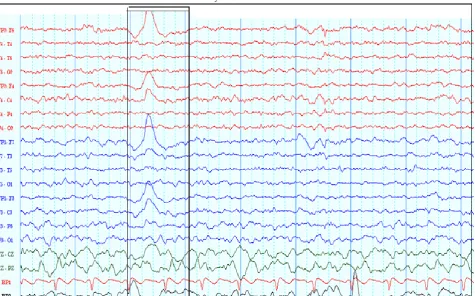 Fig 6: Eye blink artefact shown in window 