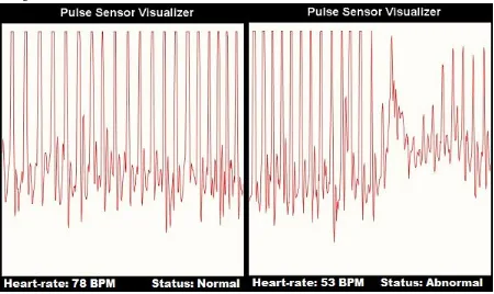 Fig. 9 Pulse-sensor reading of a normal person and an Asphyxia patient 