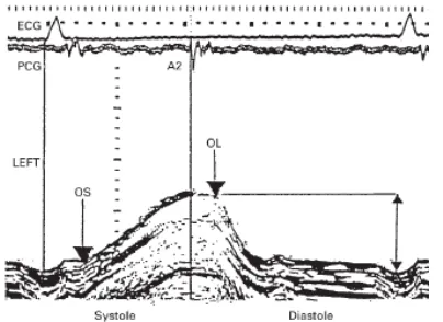Figure.1B                                                        - An example of  M mode recording of the left sided long axis along with an electrocardiogram and  phonocardiogram