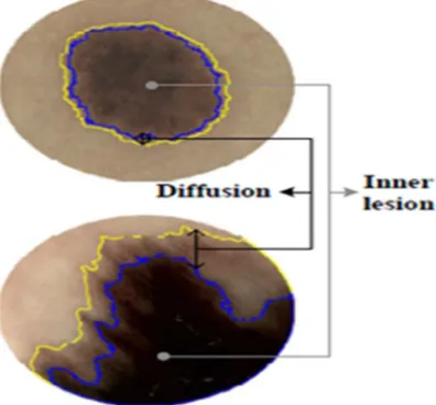 Fig. 2. Generating two lesion regions.  