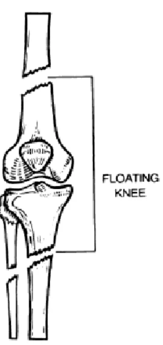 Figure 1: THE FLOATING KNEE 