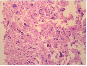 Fig 3Glioblastoma multiforme with marked nuclear atypia, bizarre nuclei and mitotic figures (H&E X 90).